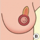 La quadrantectomia nel tumore al seno